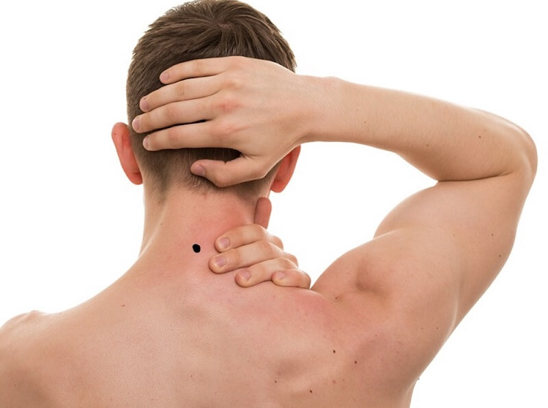Nốt ruồi sau gáy bên phải