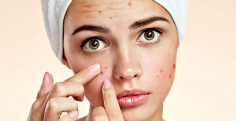 Nặn mụn xong có nên đắp mặt nạ